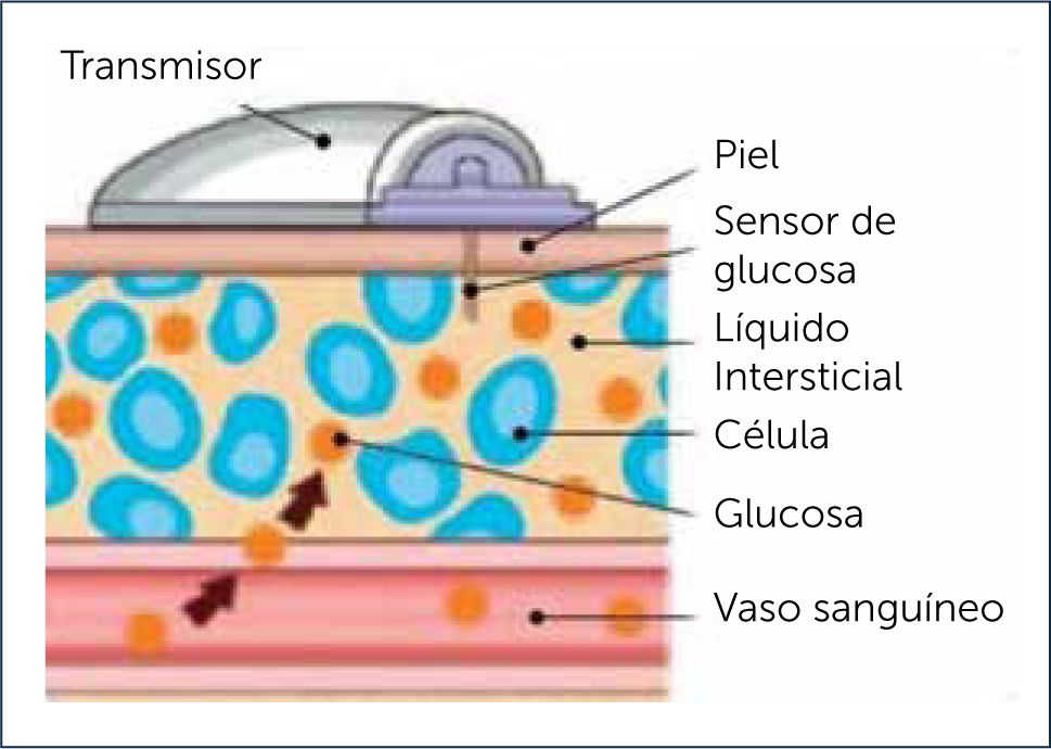 Como Medir La Glucosa Sin Glucometro - Cero Pinchazos - Glucosa Alta 